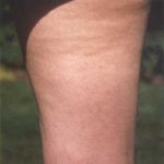 What Is Cellulite?