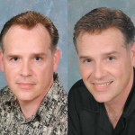 Some important things you need to know about hair replacement 