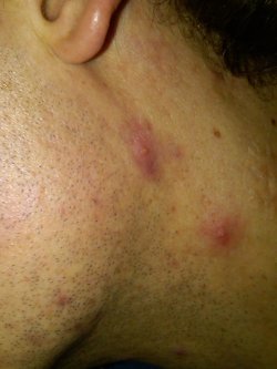 Home Remedies to treat Neck Acne