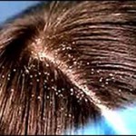 How to Eliminate Dandruff Naturally
